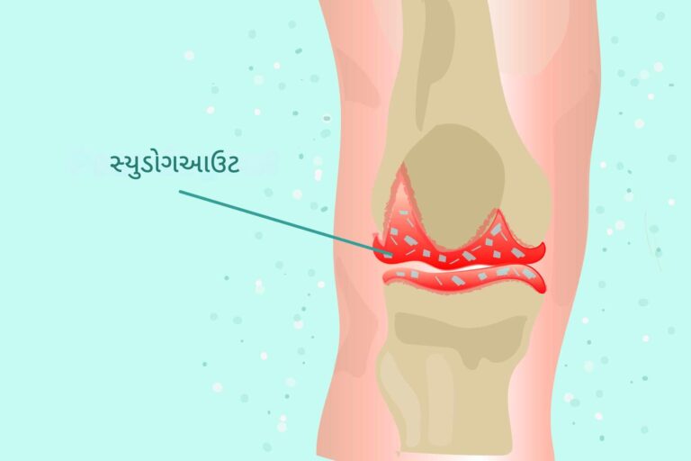 સ્યુડોગાઉટ