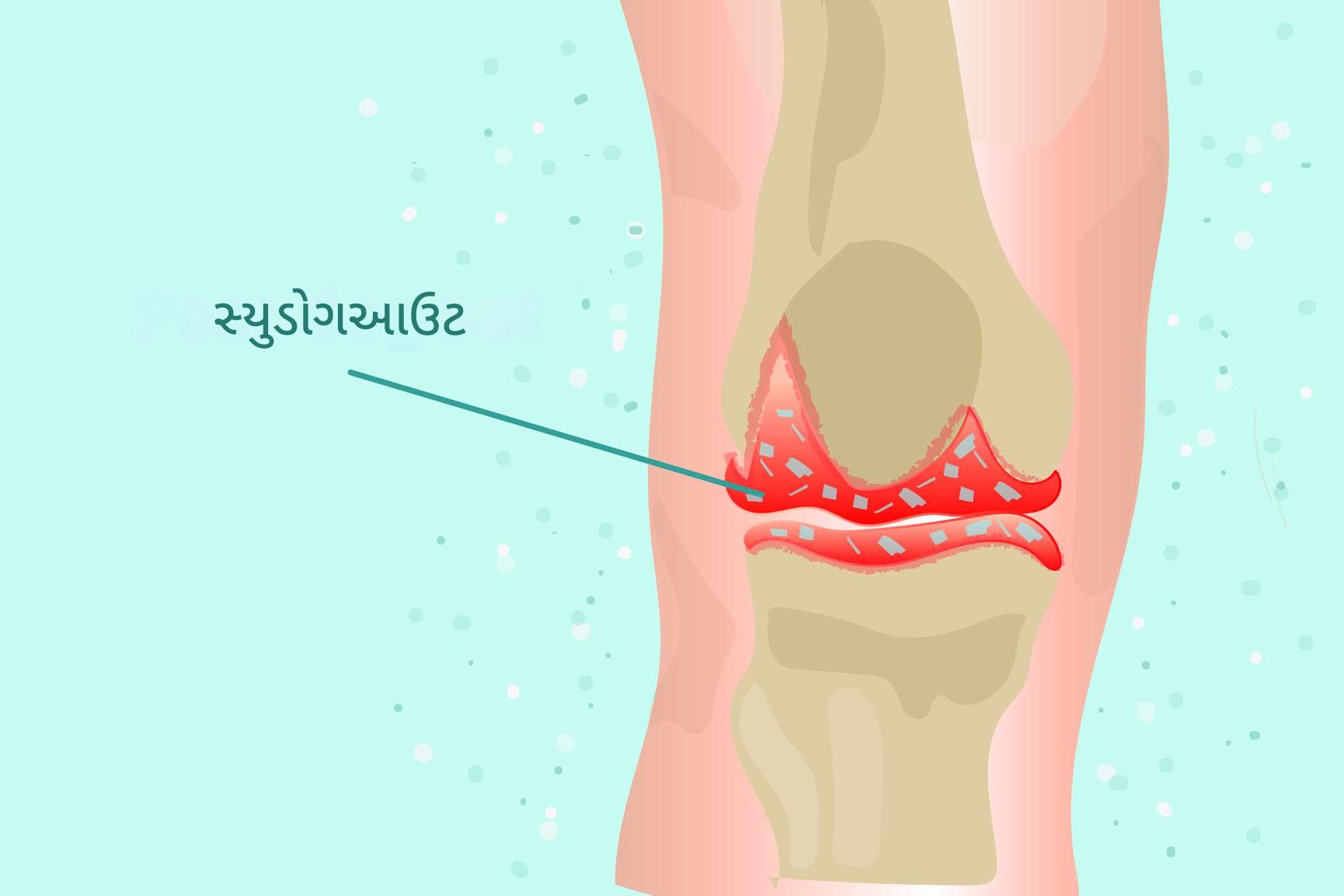 સ્યુડોગાઉટ