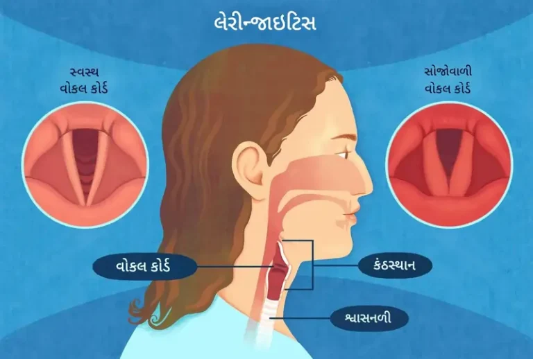 સ્વરપેટીનો સોજો