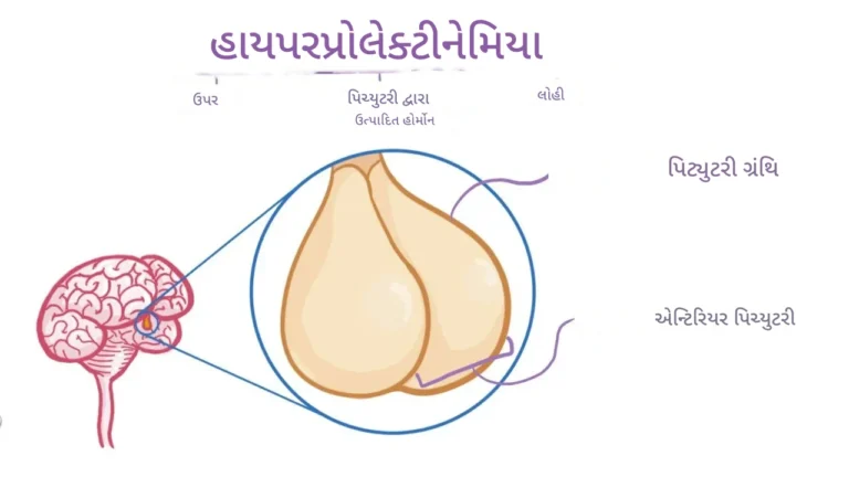 હાઇપરપ્રોલેક્ટીનેમિયા