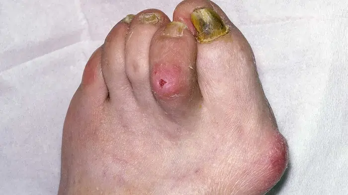 હેમર ટો (Hammer Toe)