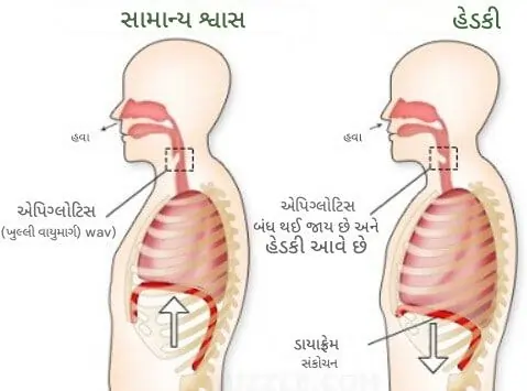 હેડકી આવતી હોય તો શું કરવું?