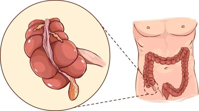 એપેન્ડિક્સ એટલે શું