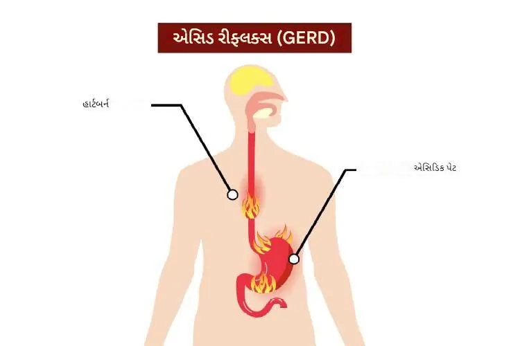 ઓડકાર કેમ આવે છે