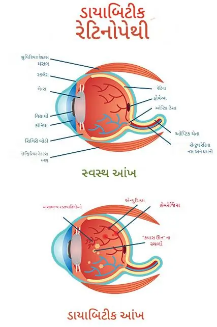 ડાયાબિટીક રેટિનોપથી
