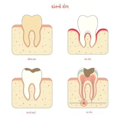 દાંતનો દુખાવો થવાના કારણો