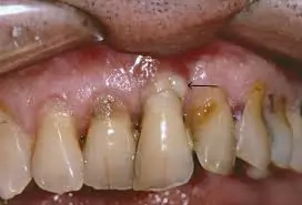 પાયોરિયા એટલે શું