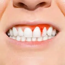 પેઢા માંથી લોહી