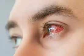 રેટિનાલ હેમરેજ