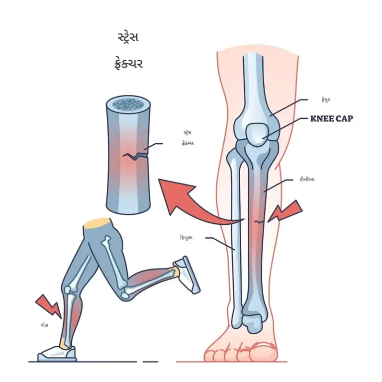 સ્ટ્રેસ ફ્રેક્ચર (Stress Fracture)