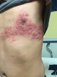 હર્પીસ ઝોસ્ટર