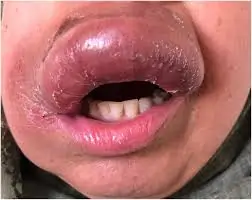 હોઠ પર સોજો એટલે શું