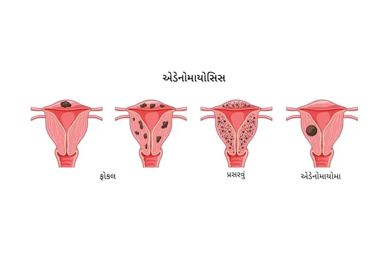 એડેનોમાયોસિસ (Adenomyosis)