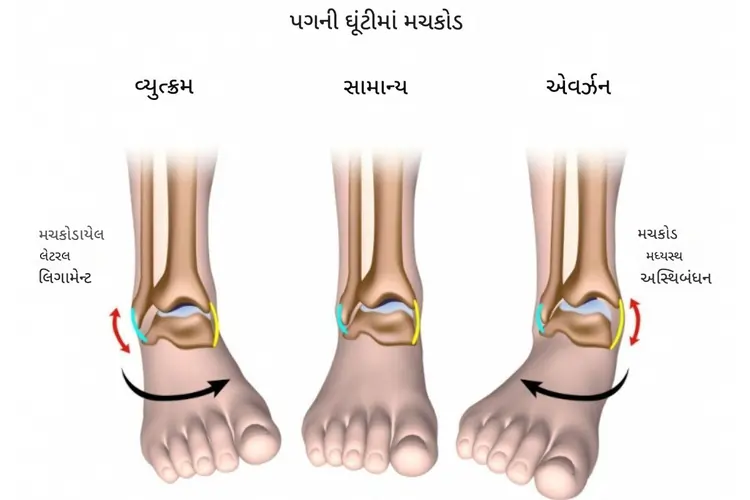એન્કલ સ્પ્રેઇન માટે ફિઝિયોથેરાપી