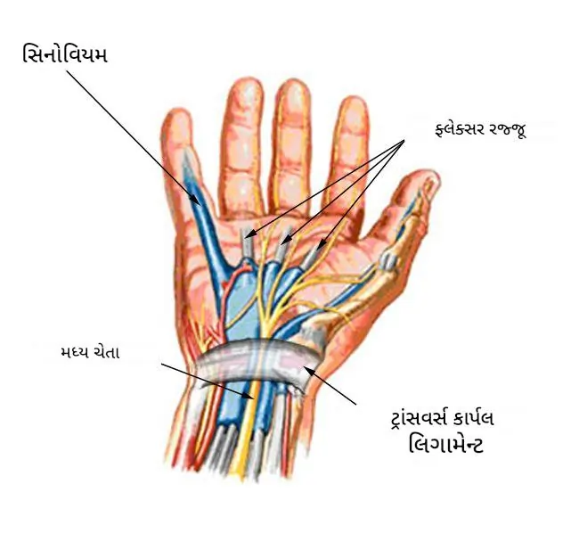 કાર્પલ ટનલ સિન્ડ્રોમ