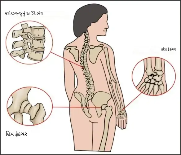 કૅલ્શિયમની અછત અને હાડકાંની સમસ્યાઓ