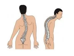 પીઠમાં ચપટી વાગવી