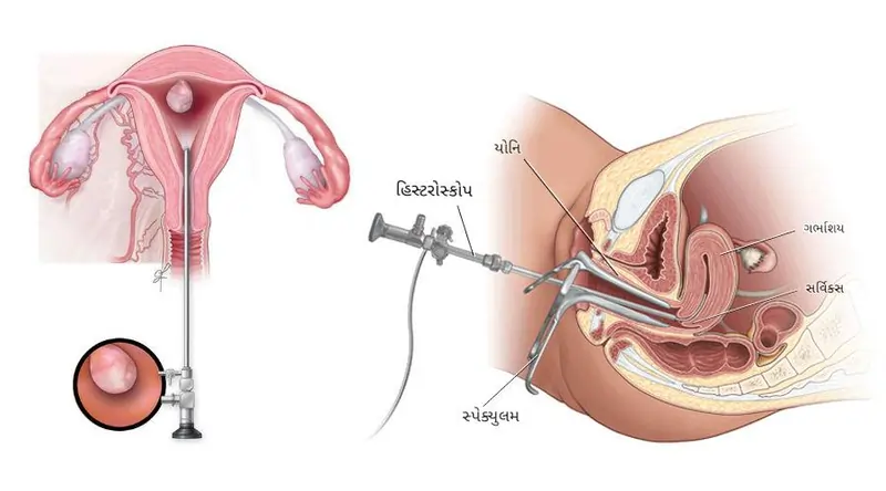 હિસ્ટરોસ્કોપી (Hysteroscopy)