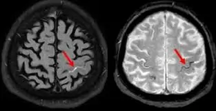 સબરાક્નોઇડ હેમરેજ