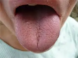 સ્જોગ્રેન્સ સિન્ડ્રોમ