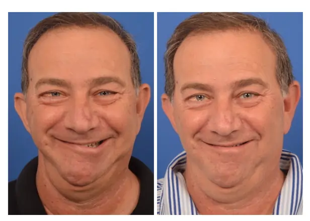 ચહેરાના લકવા (Bell’s Palsy) ની સારવાર.