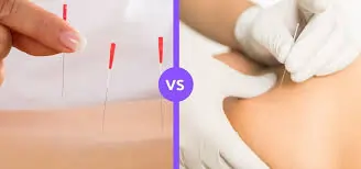 ડ્રાય નીડલિંગ (Dry Needling) અને એક્યુપંક્ચર વચ્ચેનો તફાવત.