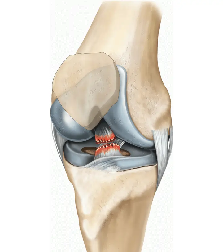 લિગામેન્ટ ઇન્જરી (ACL Tear) શું છે?