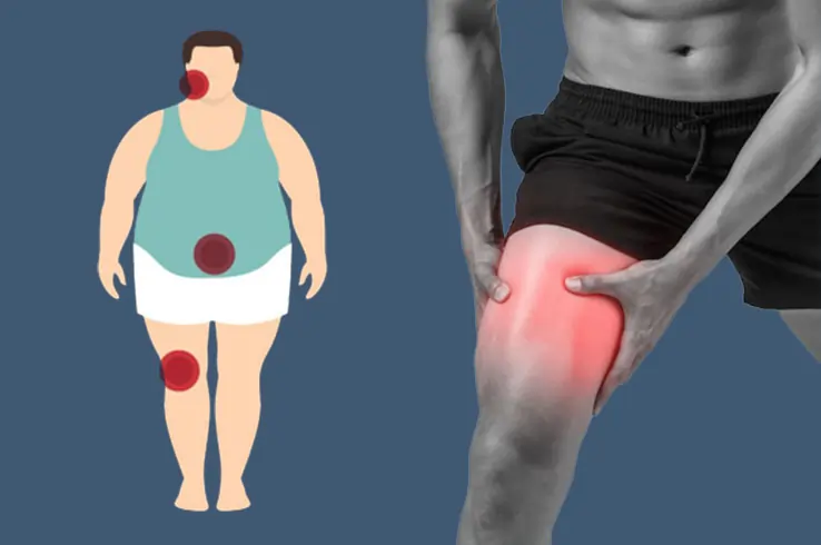 શું વજન વધવાને કારણે ઘૂંટણનો દુખાવો થાય છે?