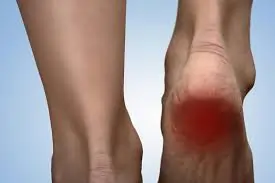 ગૃહિણીઓમાં જોવા મળતું 'એડીનો દુખાવો' (Heel Pain).