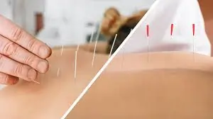 એક્યુપંક્ચર અને ફિઝિયોથેરાપીનું ડ્રાય નીડલિંગ (Dry Needling) એકબીજાથી કેવી રીતે અલગ છે?