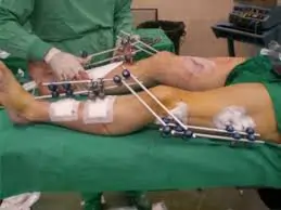 એક્સિડન્ટ પછી મલ્ટીપલ ફ્રેક્ચરવાળા દર્દીઓને પથારીમાં થતા ચાંદા (Bed Sores) થી બચાવવા.