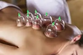 ક્યુપિંગ થેરાપી (Cupping Therapy): દુખાવો ઘટાડવા આ સારવારના ફાયદા શું છે?