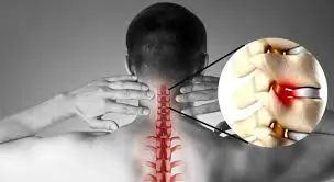 ગરદનના મણકાનો ઘસારો (Cervical Spondylosis) અને ચક્કર આવવા વચ્ચેનો સંબંધ.