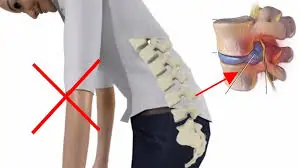 ગાદી ખસી જવાના (Herniated Disc) કિસ્સામાં ફોરવર્ડ બેન્ડિંગ (આગળ નમવું) કેમ ટાળવું જોઈએ?