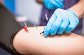 ડ્રાય નીડલિંગનો ઉપયોગ સ્નાયુઓની ગાંઠ (Trigger Points) ખોલવા માટે.