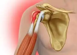 બાઇસેપ્સ ટેન્ડિનાઇટિસ: ખભાની આગળના ભાગમાં થતા દુખાવાની સારવાર.