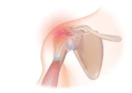 બેડમિન્ટન રમતી વખતે ખભામાં થતી ઇજા (Rotator Cuff Tear) થી બચવાની ટિપ્સ.