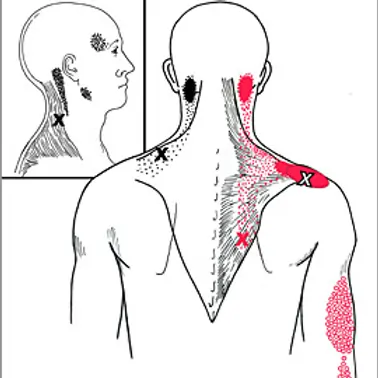 આખો દિવસ માઉસ પકડવાથી થતો 'માઉસ શોલ્ડર' (Mouse Shoulder) અને તેનો ઈલાજ.