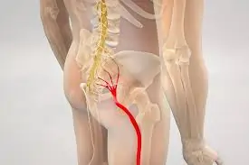 પિરીફોર્મિસ સિન્ડ્રોમ (Piriformis Syndrome): થાપાના સ્નાયુઓ જકડાઈ જવાથી થતો સાયટિકા જેવો દુખાવો.