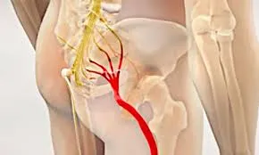 સાયટિકા અને પિરીફોર્મિસ સિન્ડ્રોમ વચ્ચેનો તફાવત કેવી રીતે જાતે પારખવો?