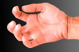 હાથ લકવાગ્રસ્ત થયા પછી સ્પાસ્ટીસીટી (સ્નાયુની અક્કડતા) ઘટાડવાની રીતો.