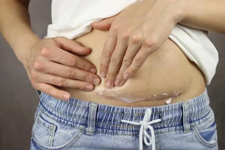 સિઝેરિયનના ડાઘ (C-section Scar) ની આસપાસની જકડાયેલી ચામડીને મસાજથી છૂટી કરવી.