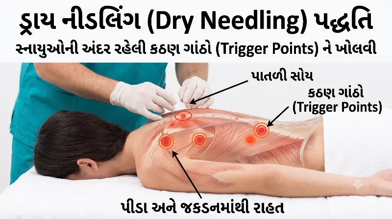ડ્રાય નીડલિંગ સ્નાયુની ગાંઠ અને દુખાવાની સારવાર