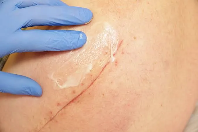 સર્જરી પછીના ડાઘ (Scar Tissue) ને નરમ કરવા માટેની ખાસ મસાજ ટેકનિક.