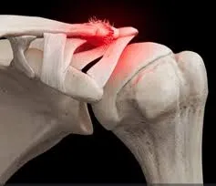 એસી જોઈન્ટ (Acromioclavicular Joint) ની મચકોડ: ભારે વજન ઊંચકતી વખતે થતી ઈજા.