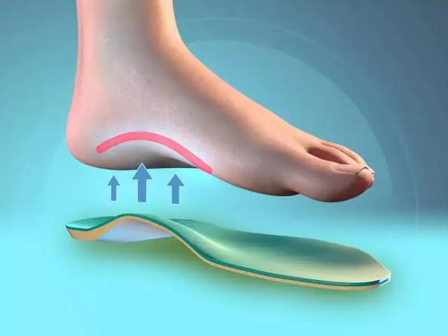પગરખાંમાં આર્ચ સપોર્ટ (Arch Support) ક્યારે જરૂરી છે અને ક્યારે સ્નાયુબદ્ધ કસરત પૂરતી છે?