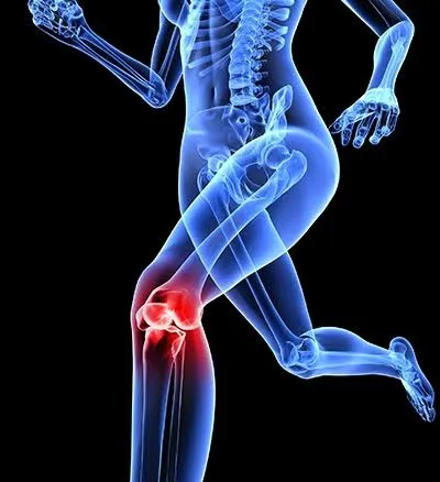 પટેલોફેમોરલ પેઇન સિન્ડ્રોમ (Patellofemoral Pain Syndrome): ઢીંચણની ઢાંકણી નીચે થતો દુખાવો.