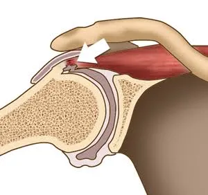 પાછળ હાથ લઈ જતી વખતે ખભામાં અટકાવ આવવો (Internal Rotation Deficit) અને સ્ટ્રેચ.