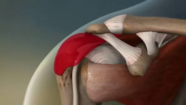સબએક્રોમિયલ બર્સાઇટિસ (Subacromial Bursitis): ખભામાં સોઇ જેવી પીડા થવાના કારણો.